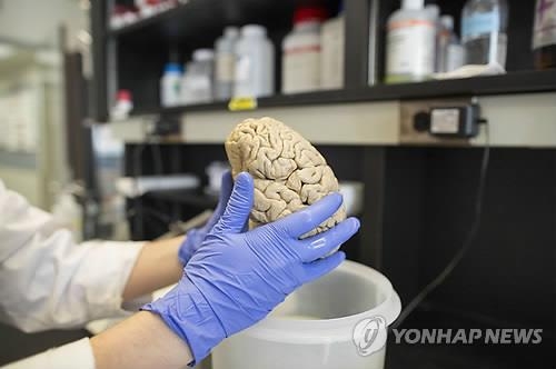 "분노조절장애, 뇌 연결조직 결함이 원인" - 2