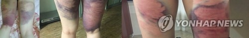 선배 폭행으로 다리에 피멍 든 대학생들