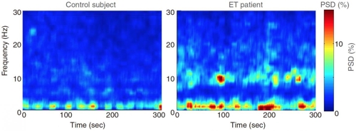 대조군보다 뇌파가 강한 본태 떨림 환자의 EEG(우측).