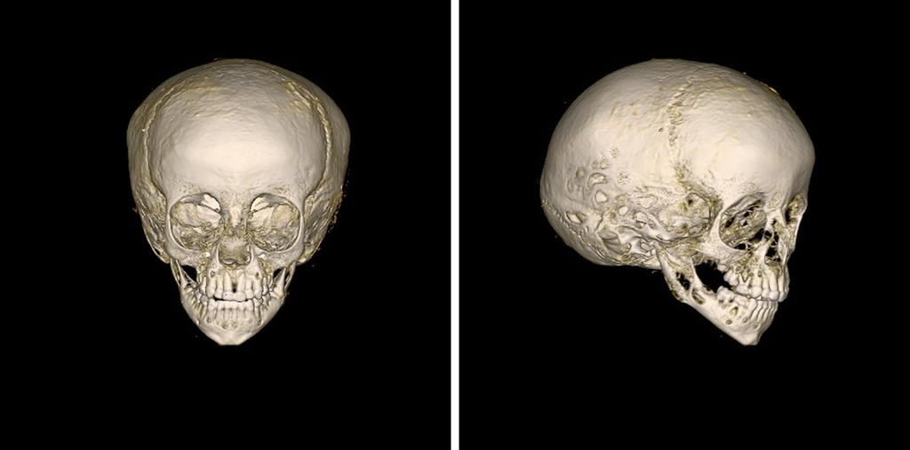 3D 이미지로 복원된 소년의 두개골