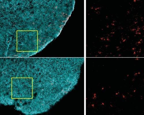 암세포를 공격하는 CD8+ T세포