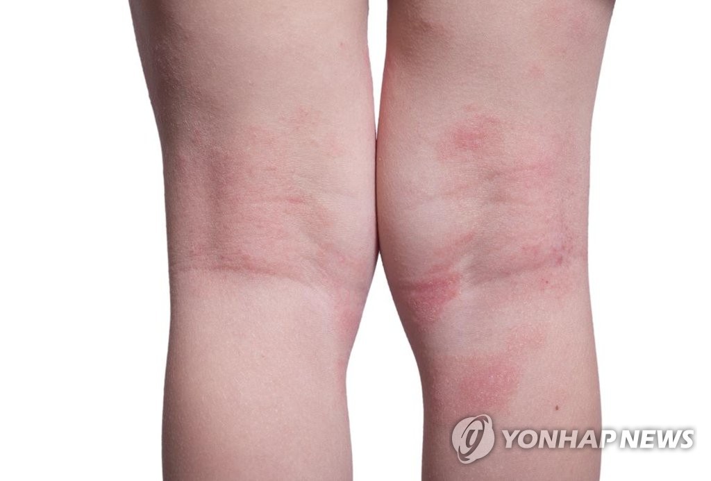 아토피 피부염