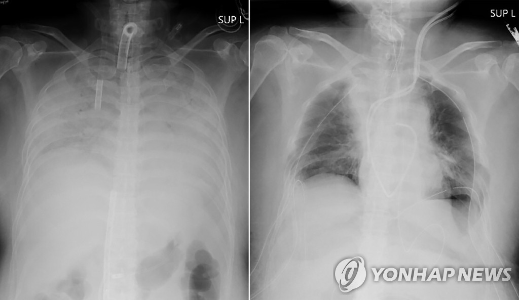 코로나19 후유증 앓다 세계 최초로 생체 폐 이식받은 일본인