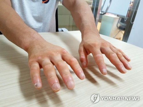 South Korean judoka An Ba-ul shows his hands ahead of training at the National Training Center in Jincheon, North Chungcheong Province, on Aug. 10, 2018. (Yonhap) 