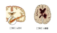 '뚝 떨어진 기온에 혈관도 화들짝'…심혈관질환 주의보