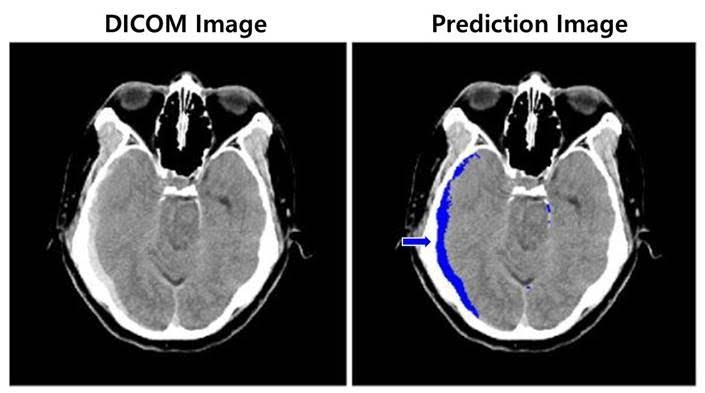 뇌출혈이 의심되는 환자의 뇌 CT 영상(왼쪽)과 뇌출혈 영상 판독 AI 모델이 출혈 병변(화살표) 존재와 위치를 식별한 영상(오른쪽) [SK C&C 제공. 재판매 및 DB 금지]