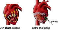 "삽입형 제세동기 대체기술 개발…통증없이 부정맥 진단·치료"