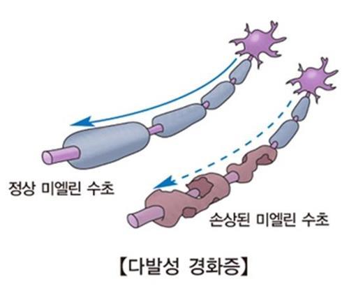 Groundbreaking Study Reveals Early Symptoms of Multiple Sclerosis