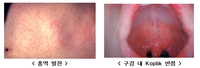 국내 홍역환자, 작년의 1.4배…%22베트남 등 해외여행시 주의%22