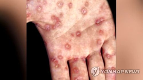 제주 매독·수두·폐렴구균 발생률 전국 평균보다 높아 | 연합뉴스 제주 매독·수두·폐렴구균 발생률 전국 평균보다 높아 | 연합뉴스