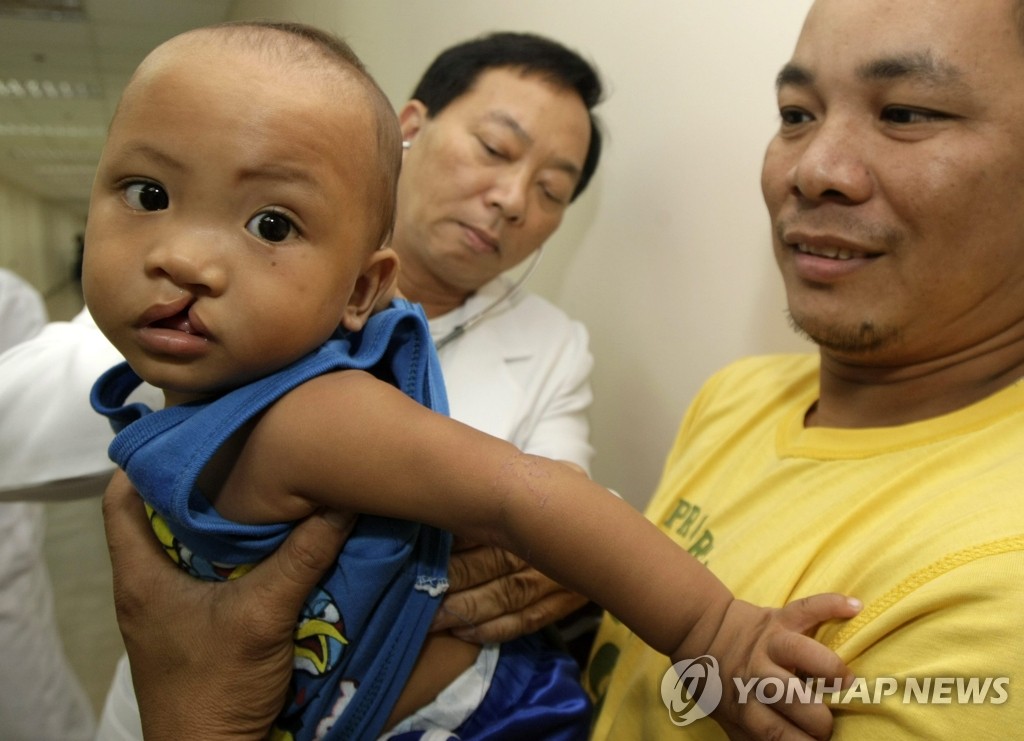 소아선천성 질병인 구순구개열로 진료를 받고 있는 아기(EPA=연합뉴스, 자료사진)