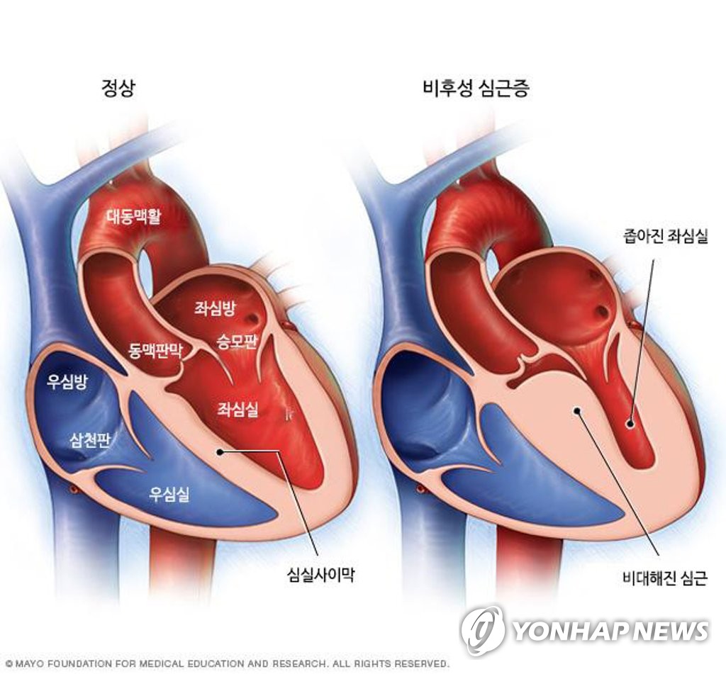 정상 좌심실(左)과 비대 좌심실(右)